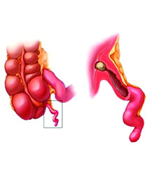 Blockage of the opening in the appendix